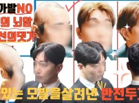 항암 반전두가발 공개